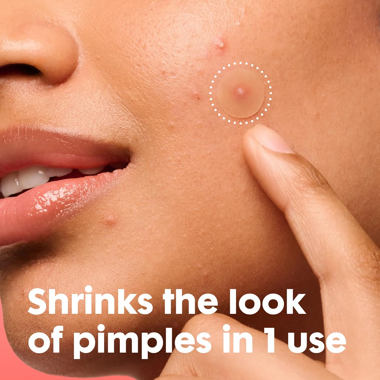 acne pimple patches, nighttime acne patcher, best acne patch